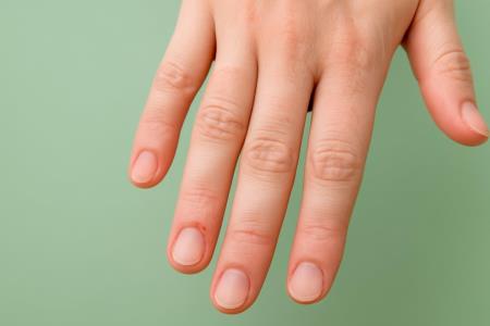 Do you know which are the first symptoms of cancer that first appear on the hands?