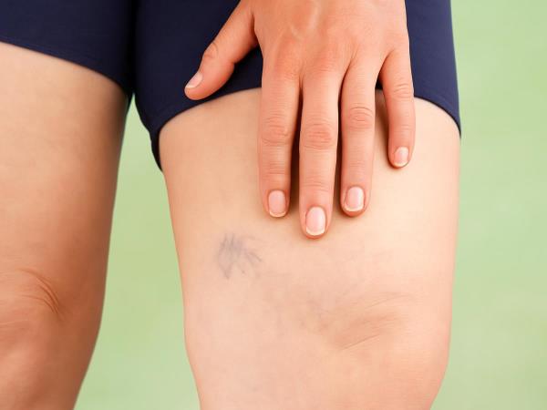 How to Prevent Vein Bursting and Why It’s Not Just a Cosmetic Problem